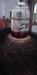 jasa bekam di Pekanbaru